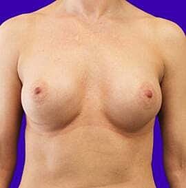 Breast Augmentation Before & After