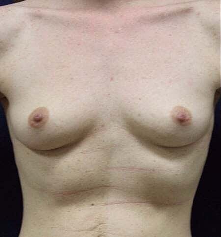Breast Augmentation Before & After