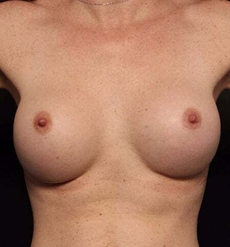 Breast Augmentation Before & After
