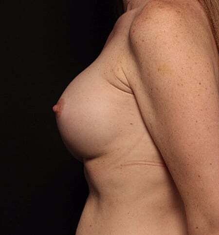 Breast Augmentation Before & After