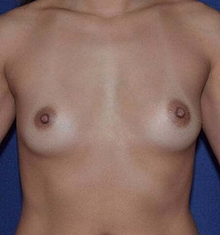 Breast Augmentation Before & After