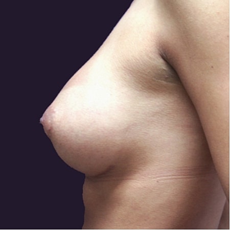 Breast Augmentation Before & After