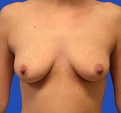 Breast Augmentation Before & After
