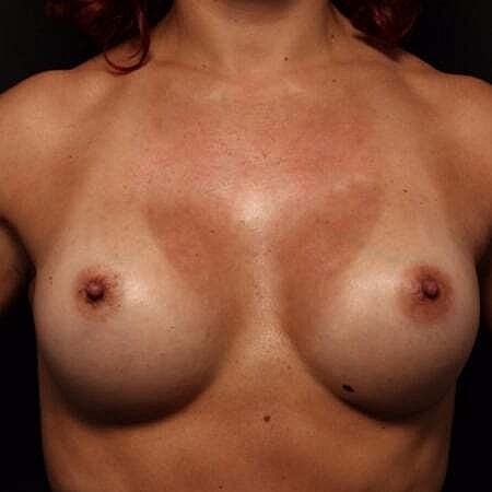 Breast Augmentation Before & After