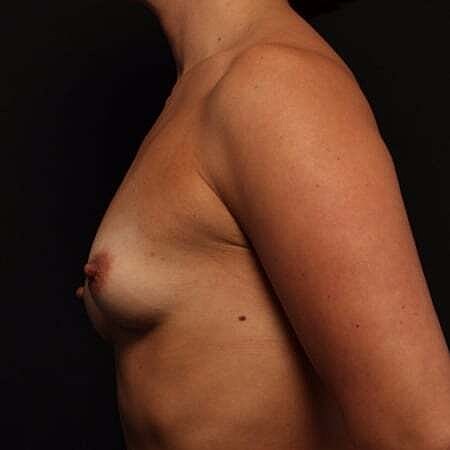 Breast Augmentation Before & After