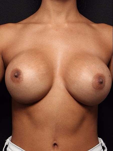 Breast Augmentation Before & After