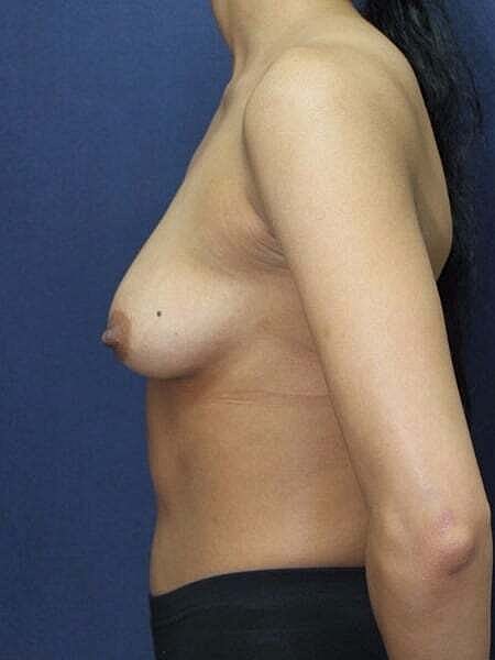 Breast Augmentation Before & After