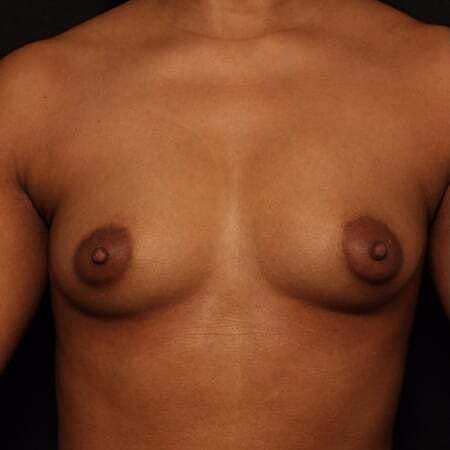 Breast Augmentation Before & After