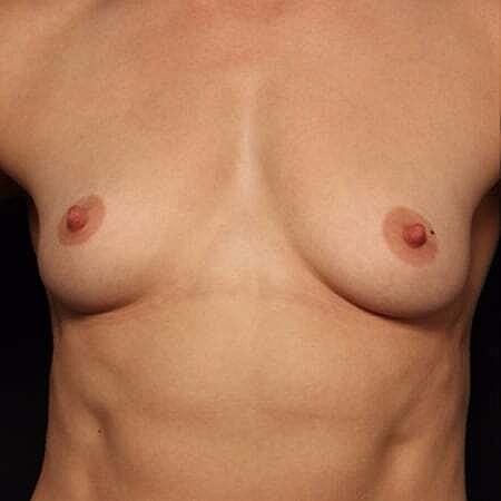 Breast Augmentation Before & After