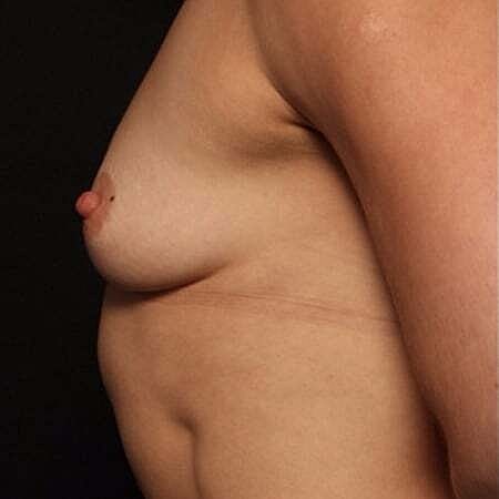 Breast Augmentation Before & After