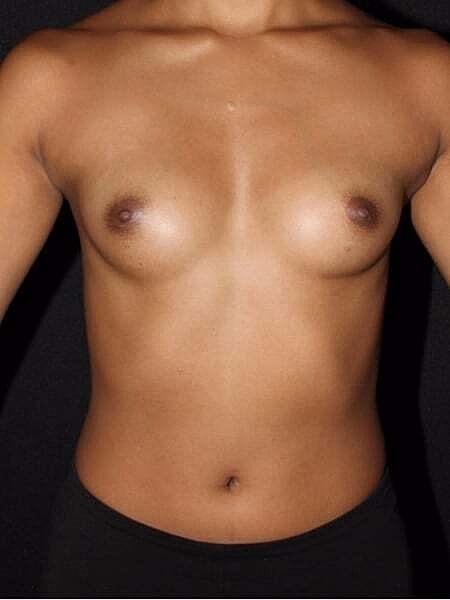 Breast Augmentation Before & After