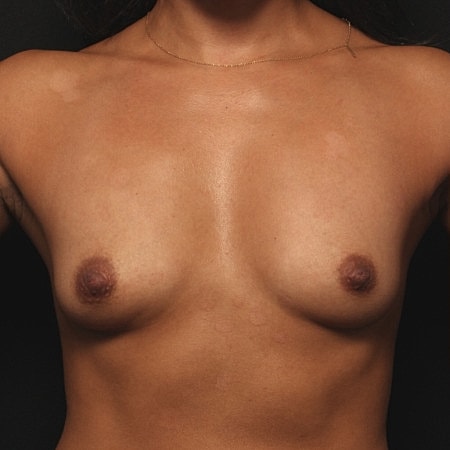 Breast Augmentation Before & After