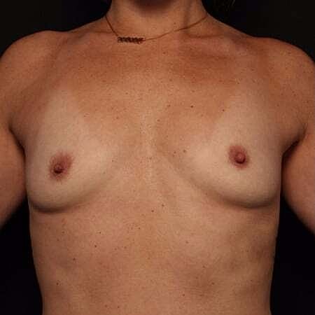 Breast Augmentation Before & After