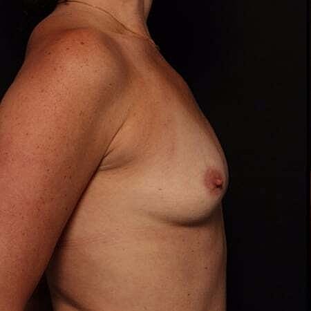 Breast Augmentation Before & After