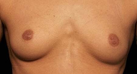 Breast Augmentation Before & After