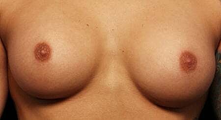 Breast Augmentation Before & After