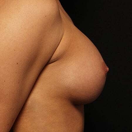 Breast Augmentation Before & After
