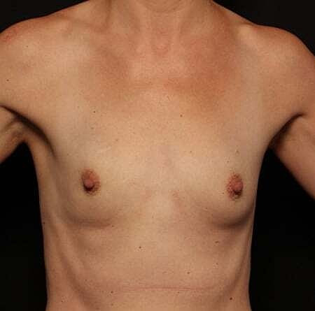 Breast Augmentation Before & After