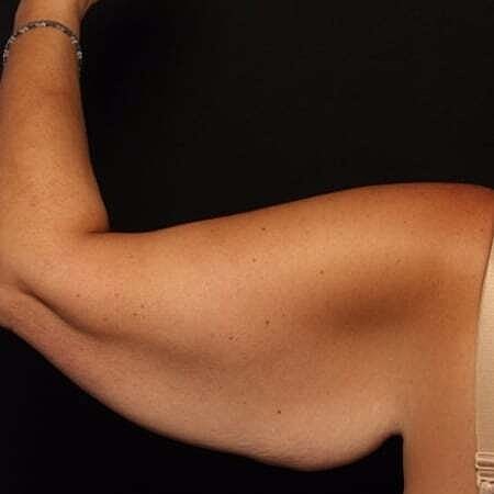 Arm Lift Before & After