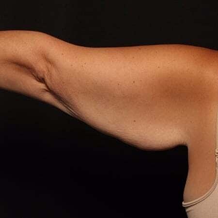 Arm Lift Before & After
