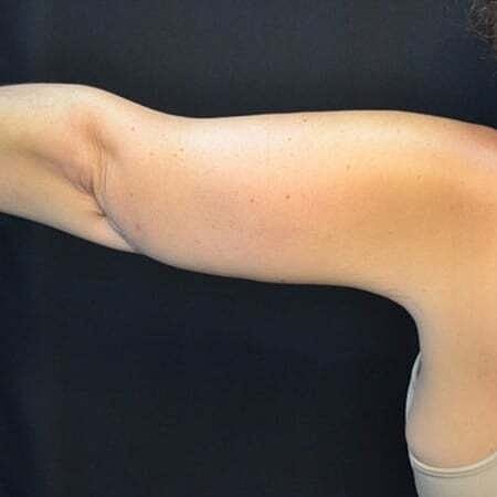 Arm Lift Before & After