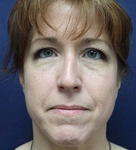 Rhinoplasty Before & After