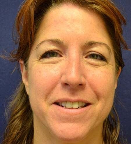 Rhinoplasty Before & After