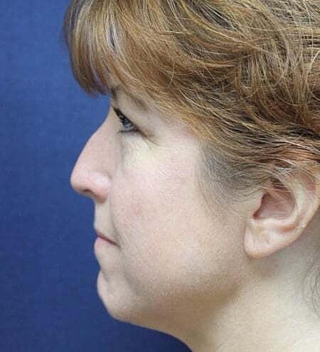 Rhinoplasty Before & After