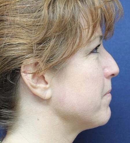 Rhinoplasty Before & After