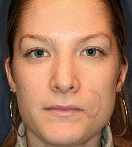Rhinoplasty Before & After