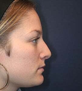 Rhinoplasty Before & After