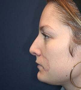 Rhinoplasty Before & After