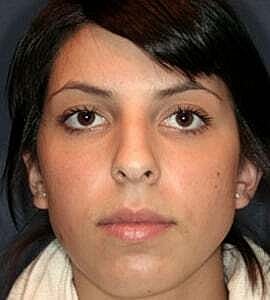 Rhinoplasty Before & After