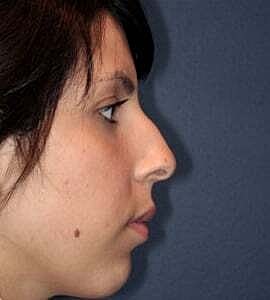 Rhinoplasty Before & After