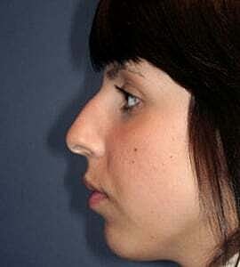 Rhinoplasty Before & After
