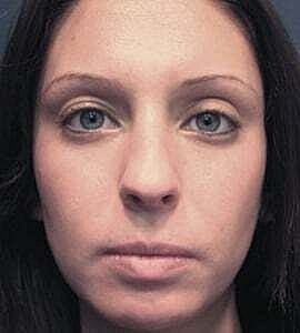 Rhinoplasty Before & After