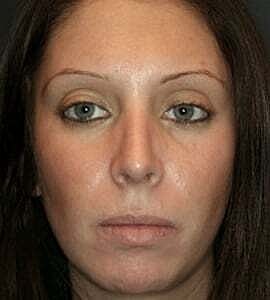 Rhinoplasty Before & After