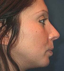 Rhinoplasty Before & After