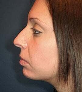 Rhinoplasty Before & After