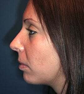Rhinoplasty Before & After