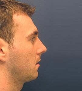 Rhinoplasty Before & After