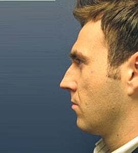 Rhinoplasty Before & After