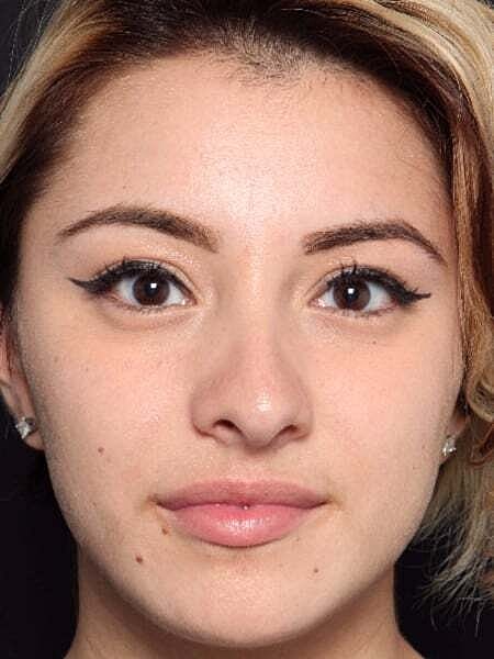 Rhinoplasty Before & After