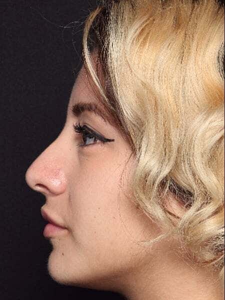 Rhinoplasty Before & After