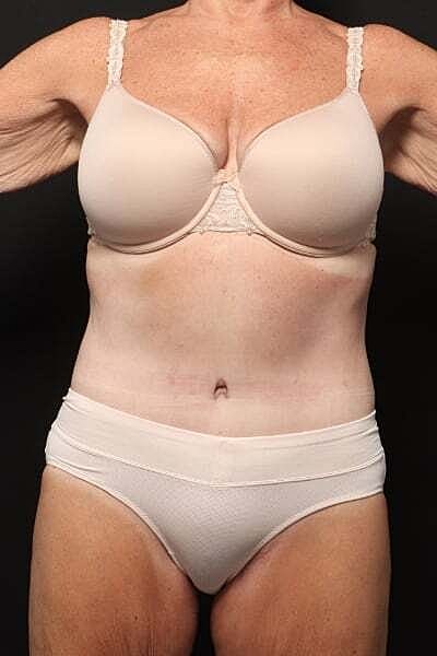 Tummy Tuck Before & After