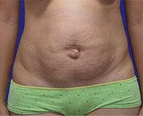 Tummy Tuck Before & After