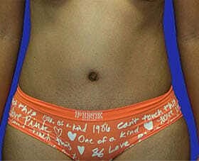 Tummy Tuck Before & After