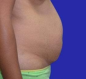 Tummy Tuck Before & After