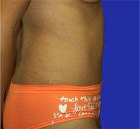 Tummy Tuck Before & After