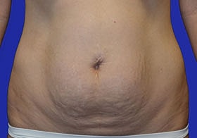 Tummy Tuck Before & After